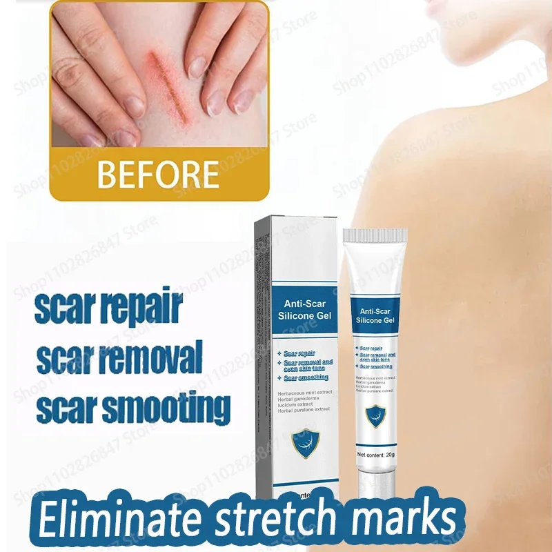 Крем для удаления шрамов во время беременности, удаление растяжек, эффективное лечение, устранение красных и белых старых хирургических следов