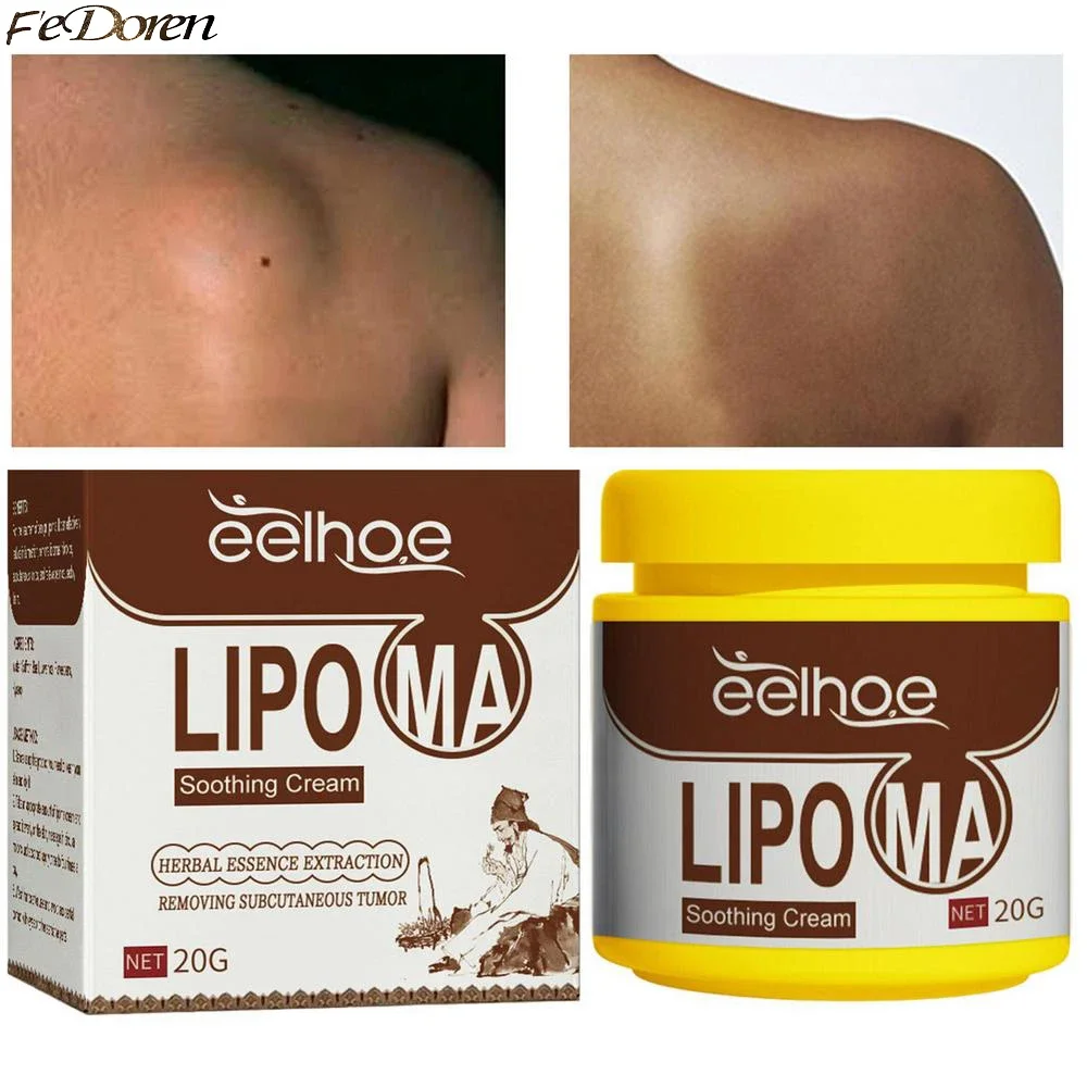 Lipoma Removal Cream Lipolysis Fat Lump Relief Cream Skin Swelling Fat Elimination Cream 20g Health Care