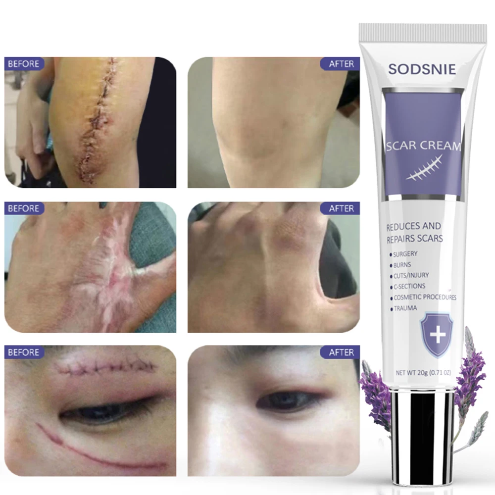 20g Scar Cream Skin Repair Scars Treatment Smooth Whitening Effective Remove Burn Stretch Marks Acne Spots Body Care Product