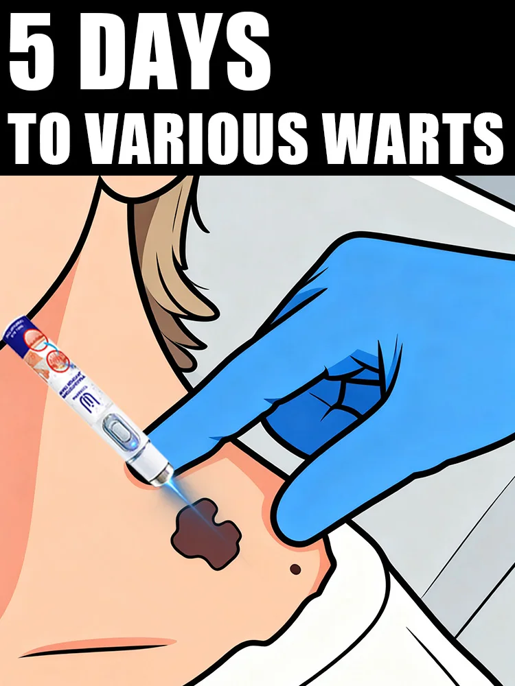 

2025 New Upgrade Blue Laser Solve Wart Tool