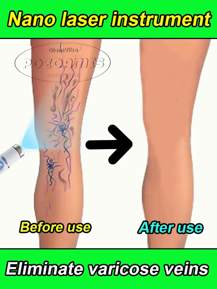 

Нанотехнология улучшает варикозное расширение вен и флебит ноги-паука.