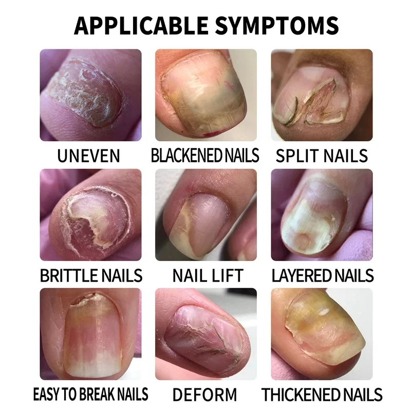 Sérum de soin de l'onychomycose, solution hydratante réparatrice pour la santé des ongles des pieds