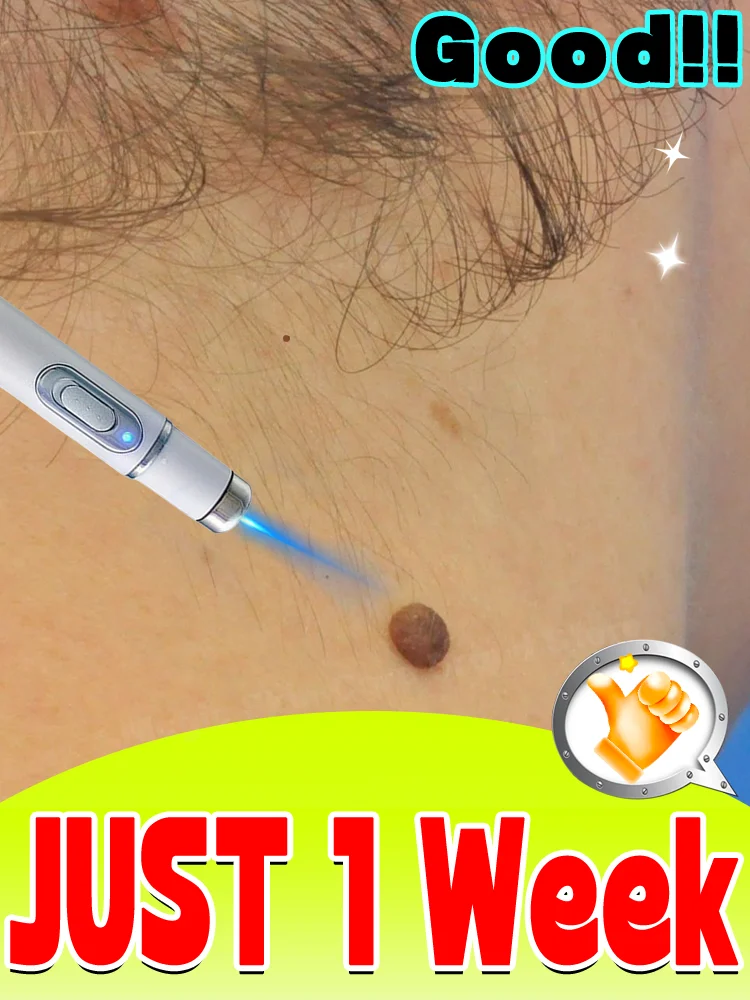 

Lᴀsᴇʀ Wᴀʀᴛs Rᴇᴍᴏᴠᴀʟ Say goodbye to unwanted skin tags Blue Light Wart Remover