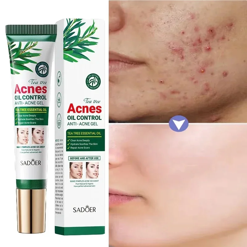 

Tea Tree Acne Removing Cream Facial Mild Moisturizing Oil Control Acne Removing Facial Gel Eliminate Acne Pimples Beauty Health