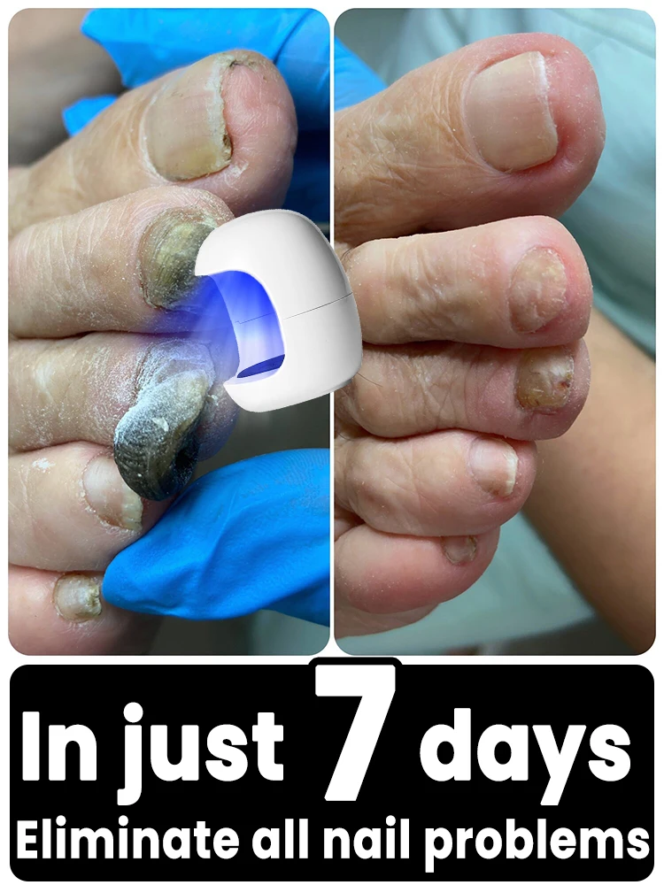 

Hot-selling laser nail fungus repair device, convenient home sterilization, say goodbye to the recurrence of nail fungus