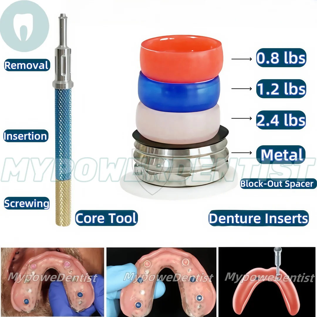 Dental Abutment Attachments Locator Inserts Caps/Remove Locator Core Tool