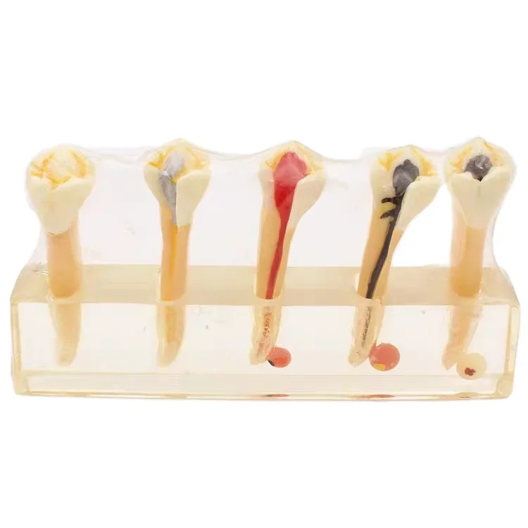 Complete simulation of endodontic treatment model from entry to occlusion