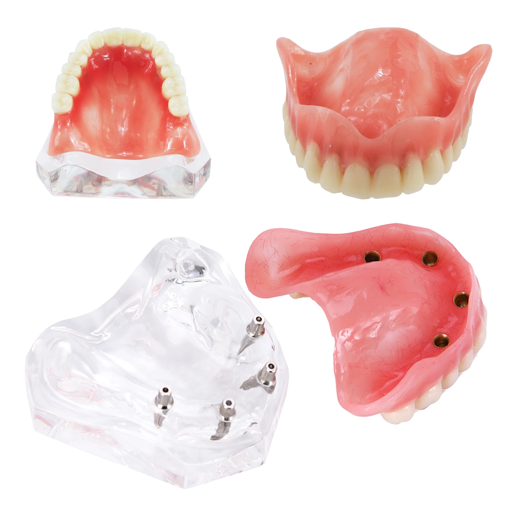 歯科歯モデル-m6001-クリアアッパー-4-インプラントオーバーデンチャー修復デモンストレーション用オーバーデンチャーの機能を説明