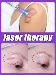 Terapia laserowa Keloid Scar