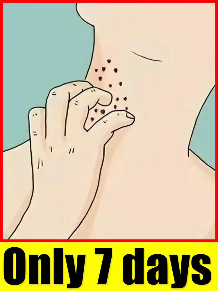 ปากกาแสงสีฟ้าสำหรับกำจัดหูด อุปกรณ์ดูแลหูด จัดส่งฟรีทุกชิ้น