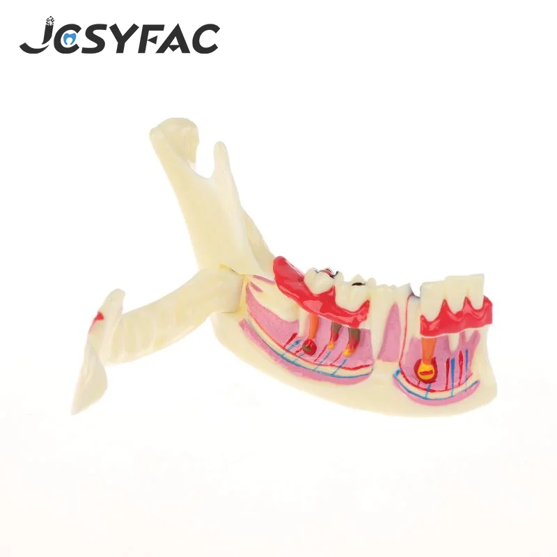 Dental Endodontic Treatment Model Anatomy Of Gums Mandible Tissue Anatomical Model Dentist Teach Study Demonstration Teeth Model