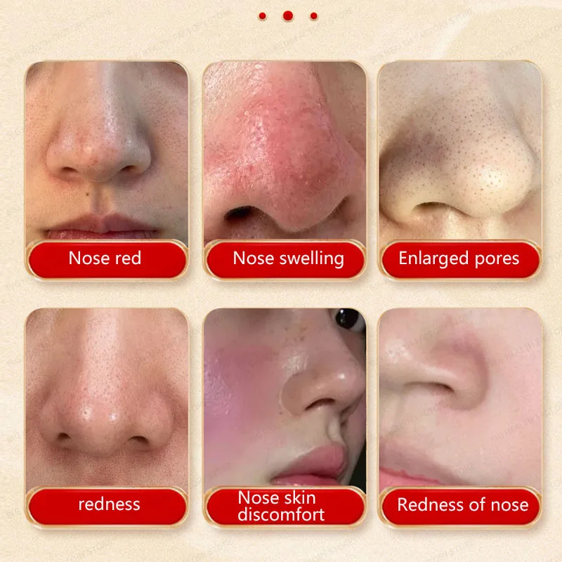 Crème de santé pour le nez, Lees de vin, nez rouge, pores dilatés, points noirs et acné, crème pour applications externes