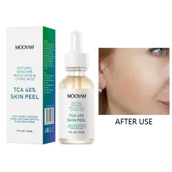 Chemical Peeling Solution TCA 40% Moisturizing Essence Glowing Skin Facial Exfoliant Pore Cleansing Serum