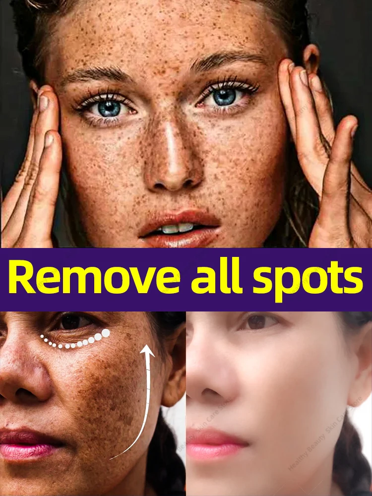 Nearly All kind of face spot can be cleaned and no rebound，90% of customer repurchase