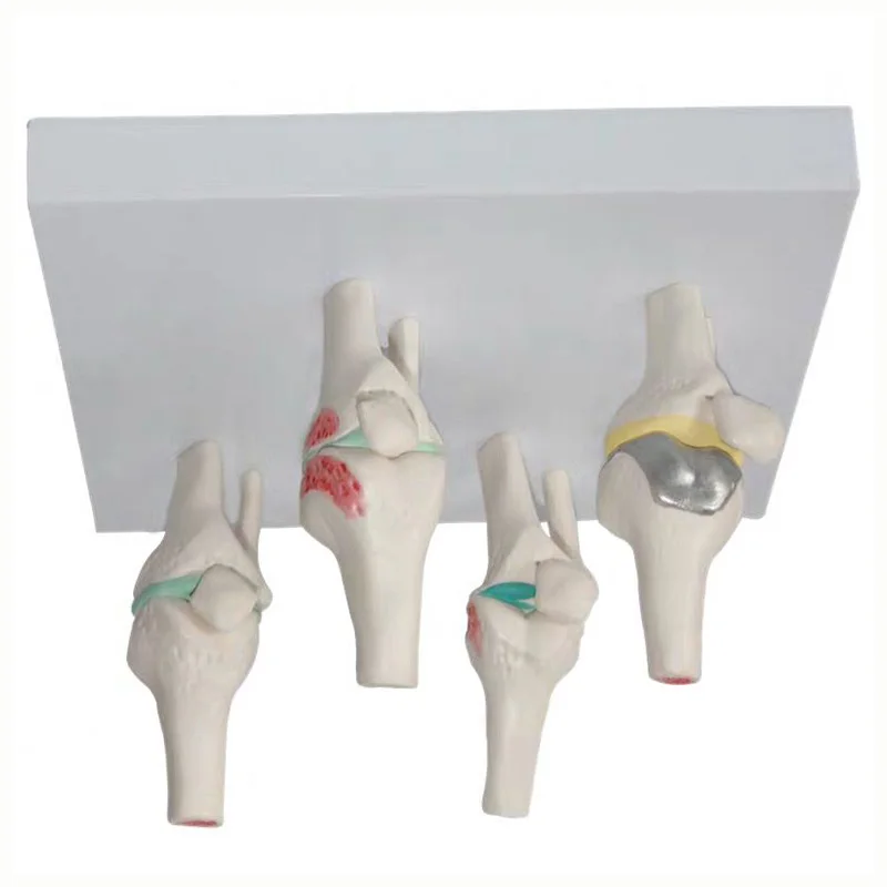 Osteoarthritis 4-stage Knee Arthritis Anatomy Model Lesion Joints Skeleton Medical Teaching Supplies