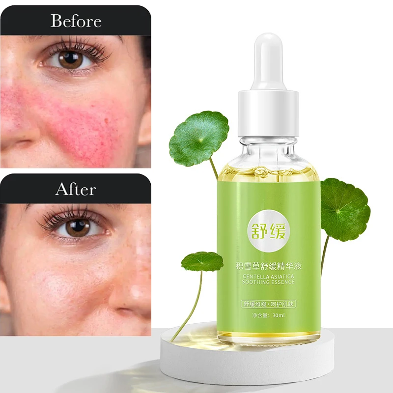 7 Day Repair Redness Serum Sooth Itching Sensitive Skin Improve Rosacea Shrink Pore Smooth Nourish Facial Skin Korean Cosmetics