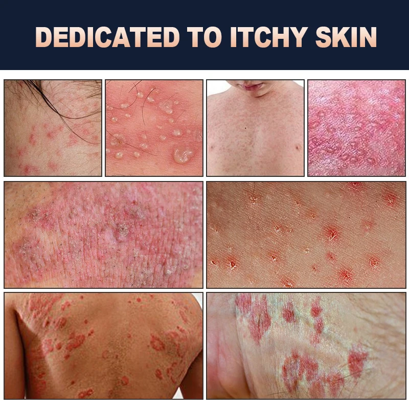 مضاد للجراثيم كريم الأكزيما مرهم إزالة رائحة الجزء الخاص التهاب الجلد المضادة للحكة Tinea Cruris عشب الجلد الطبي الصدفية كريم