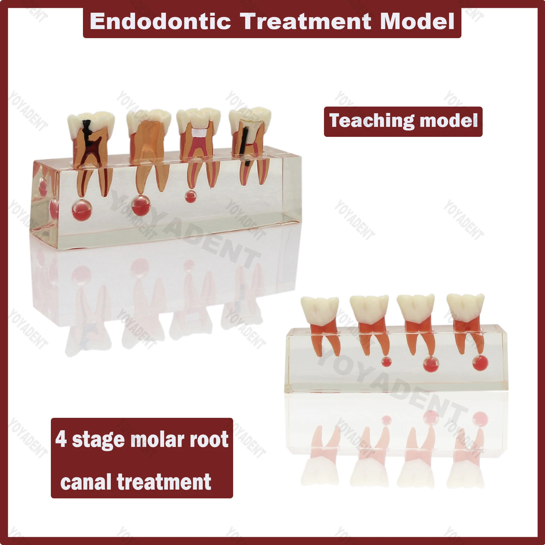 

Стоматологическая модель, эндодонтическое патологическое лечение, обучающие модели для стоматологии, анатомия корневых каналов, четкая практика, инструмент для обучения