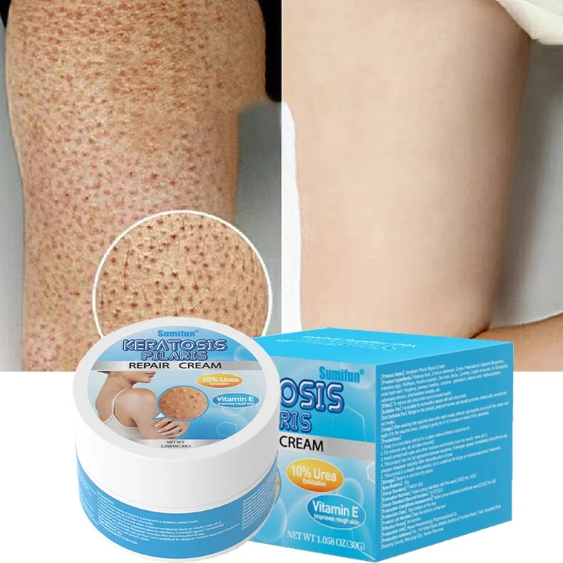 Keratosis Pilaris Repair Treatment Cream Exfoliating Removal Chicken Skin Cleaning Acne Spots Moisturizing Smooth Body Skin Care