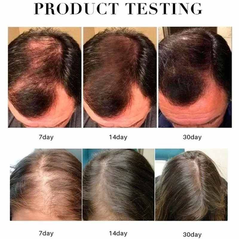 Hairloss Hair Natural Fast Growth Essential Oil Product Anti Hairloss Treatment Growth Essence Alopecia Hair Treatment for Women