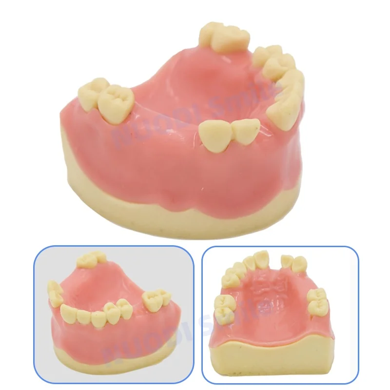 

Dental Upper Jaw Implant Model Missing Partial Teeth Basic Implant Training Model with Practice Soft Gums Dental Practice Model