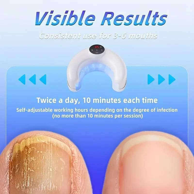 

1/2/4 Pcs Nail Fungus Light Device for Toenails and Fingernails