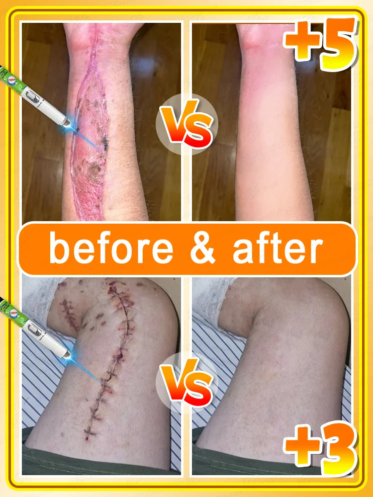 2025 latest laser pen, repair various scars