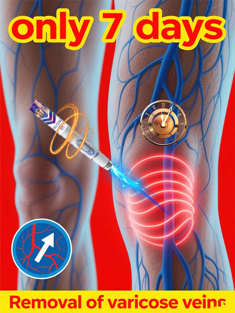 

Generation-2 Laser Says Goodbye To Spider Legs Varicose In 7 Days