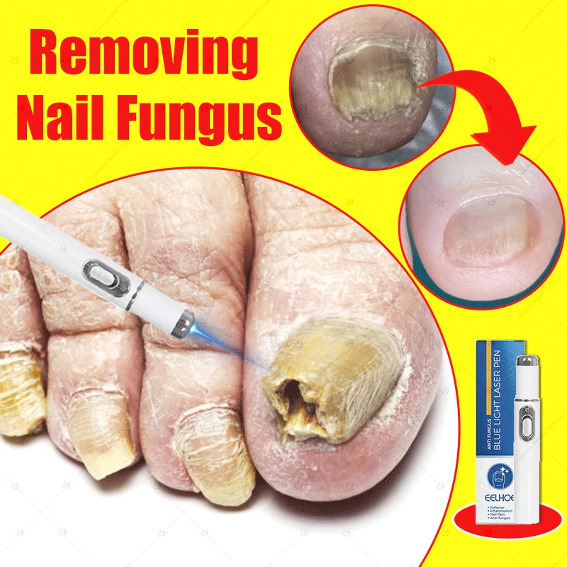 

Laser pen for nail care