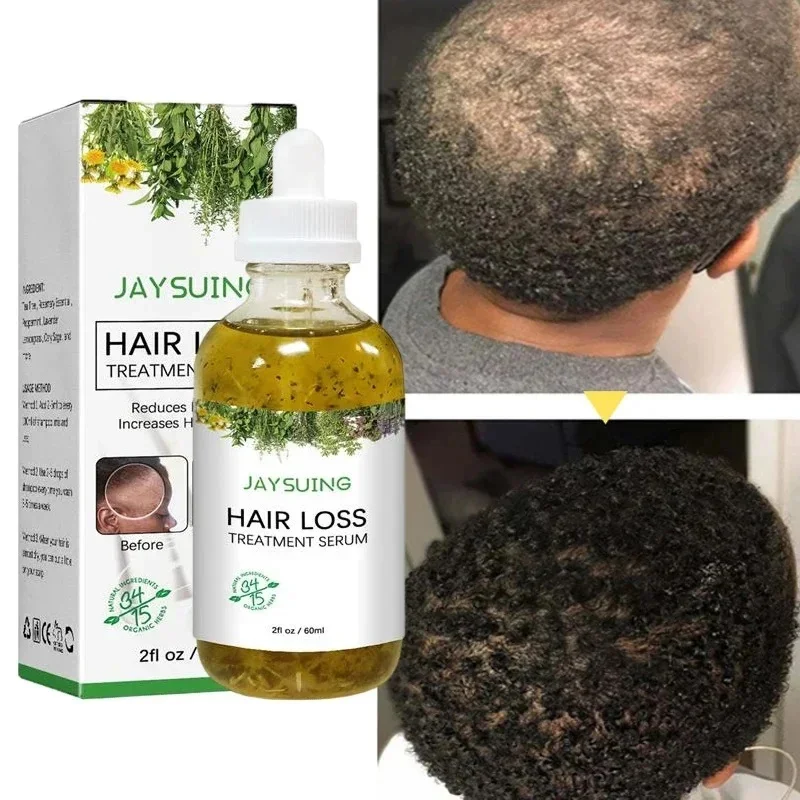 

Fast Hair Growth Serum African Crazy Traction Alopecia Anti Hair Loss Essential Oil Prevent Baldness Scalp Treatment Hair Care