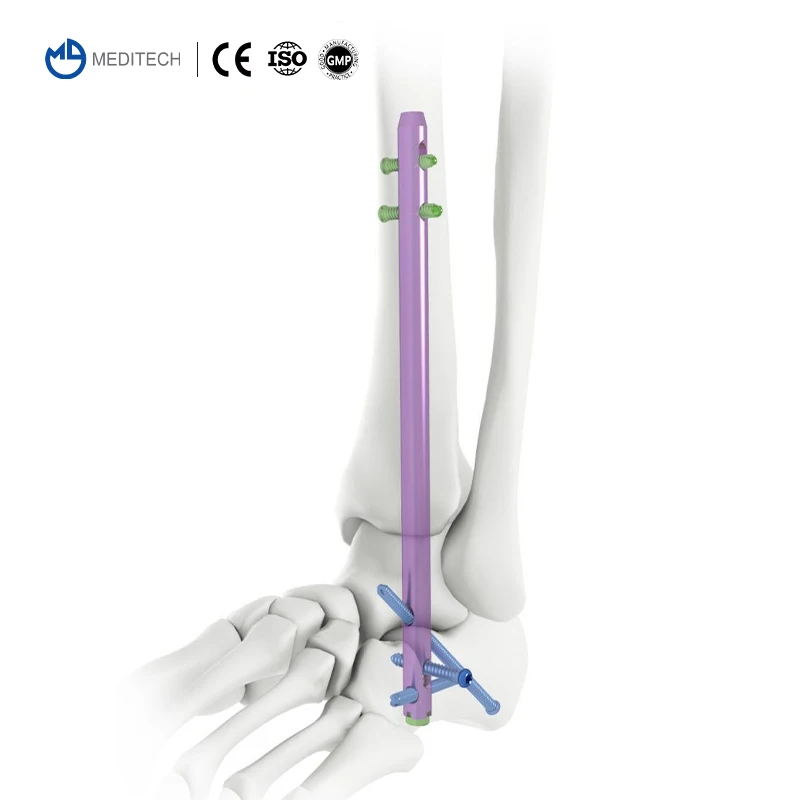 CZMEDITECH Delmar Technology Hindfoot Fusion Ankle Nail Pure Titanium Foot Plate Approach Distal Tibial Intramedullary Nail