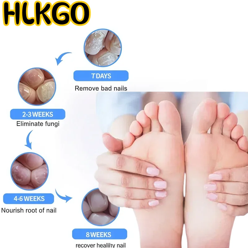 

Nail Fungus Laser Treatment, 407-910nm Gentle Therapy for Onychomycosis, USB Rechargeable Home Device