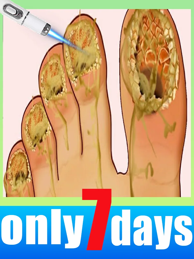 

Технология против грибка 2025 года. Инструмент для ухода за онихомикозом с лазерной ручкой. Лечение инфекции ногтей и выпадения ногтей.