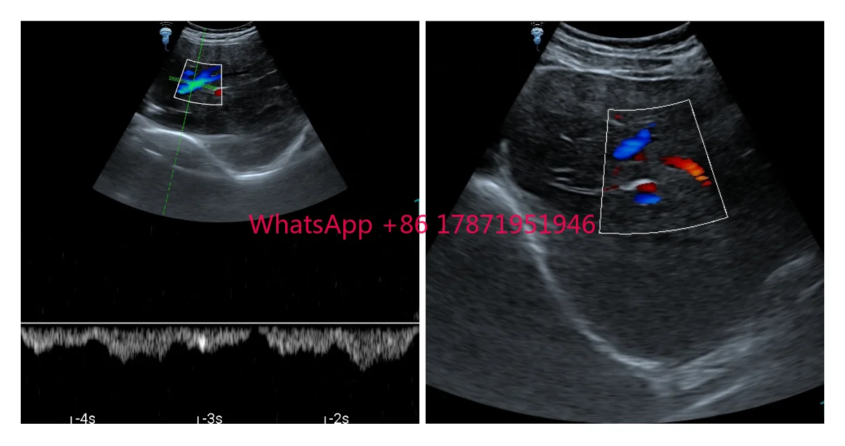 USB Type C doppler ultrasound machine price