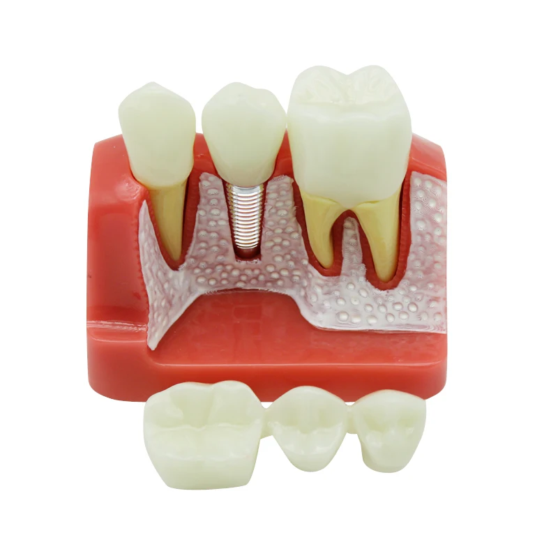 Dental Teach Implant Analysis Crown Bridge Removable Model Dental Demonstration Teeth Model 4 Times Dentistry