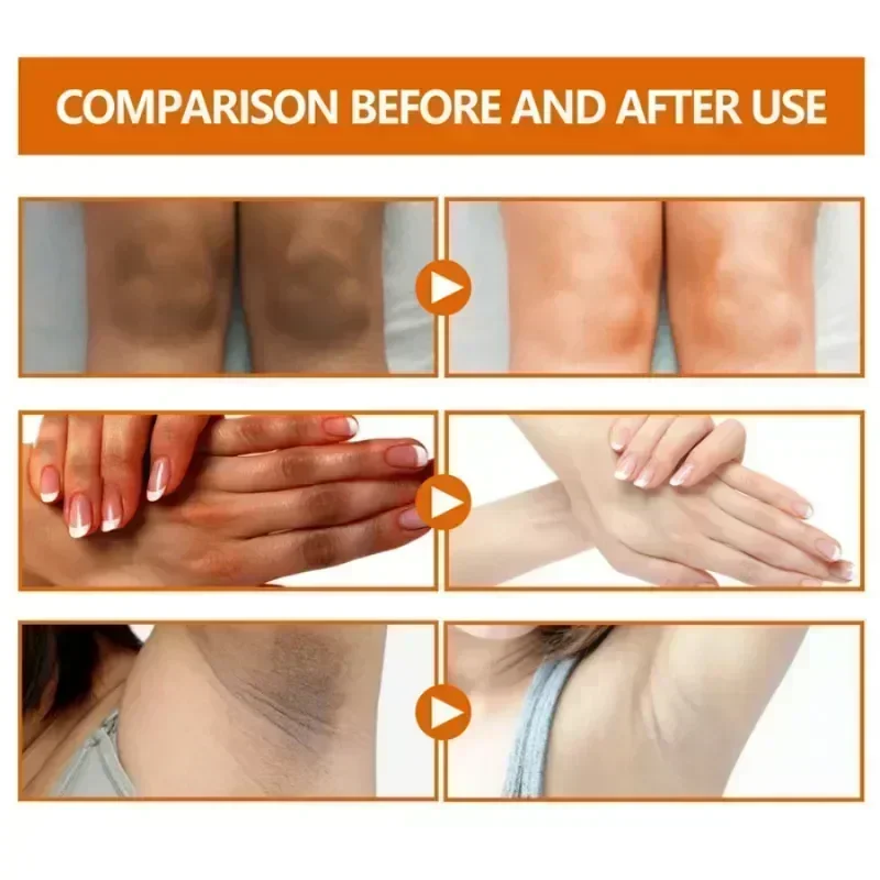 HOT SALE Dark knuckles whitening serum Elbows Armpit Beaching SerumWoman Private Part Skin Removal Dark Knuckles Strong Whitenin