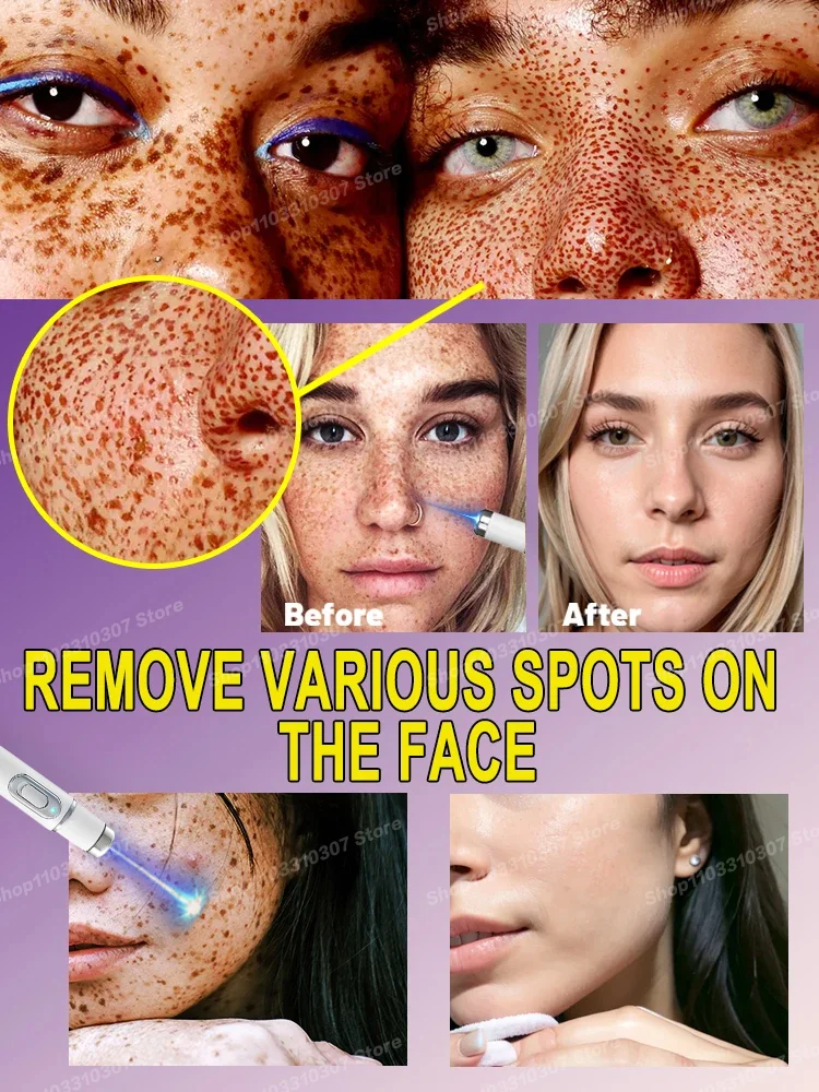 Facial spots disappear Nano laser