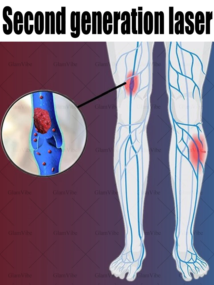 

Say goodbye to spider legs and varicose veins, recover in 7 days