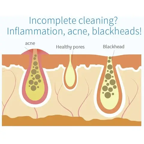 NY Peeling Skönhetsapparat Liten Bubbel Syre Injektionsinstrument Hydra Dermabrasion Aqua Ansiktsrengöring Sug Pormaskar 9 best sales dermabrasion - №5