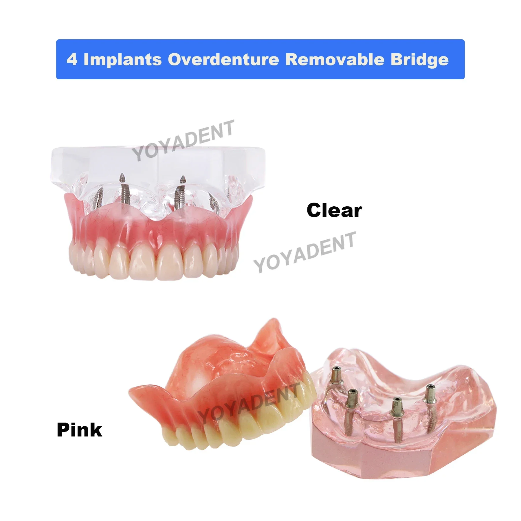 Model zębów dentystycznych z 4-implantami, mostkiem do odbudowy protez dla dentysty, implantów, model dydaktyczny Demo