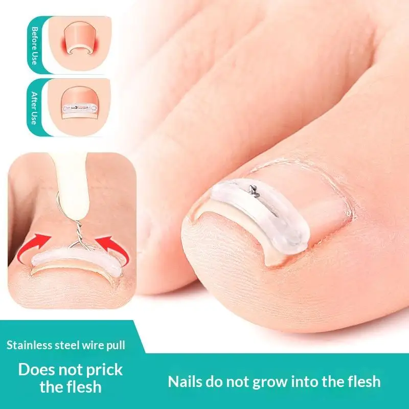 Travel Friendly Ingrown Toenail Corrector Tool Set 1 Set Pedicure Kit for Foot Nail Treatment Use
