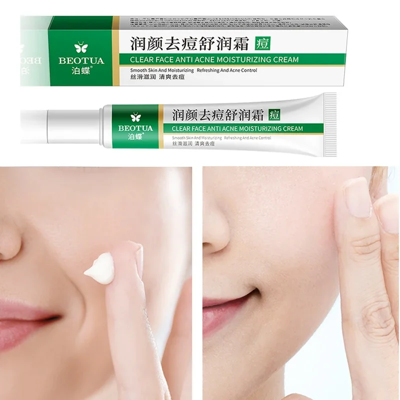 Acne Treatment Cream Face Skin Care Effective Herbal Black Dots Acne Pimple Mark Remover Anti-aging Moisturizin Whitening Cream