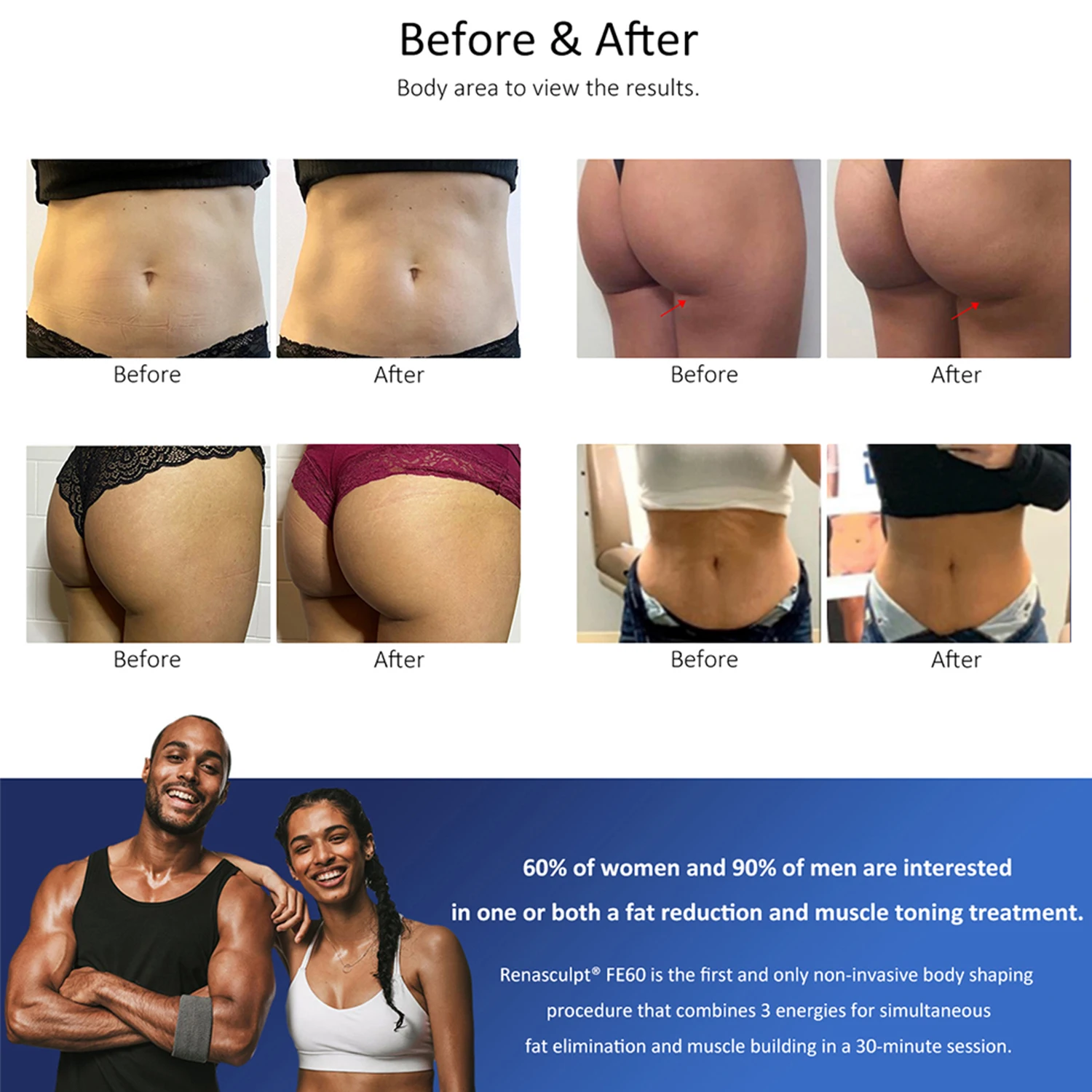 테슬라 Ems 무게추 손실 조각 기계, 지방 연소, Renasculpt Ems 조각 기계, 15