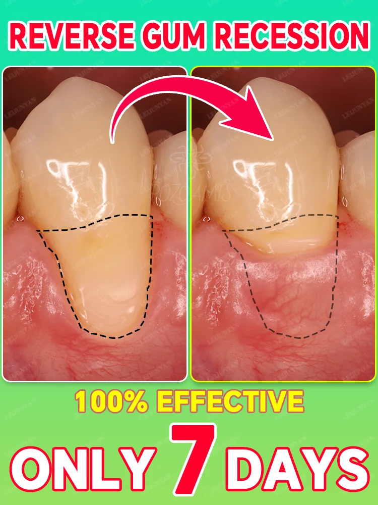 

The savior of gums, say goodbye to atrophy and bleeding