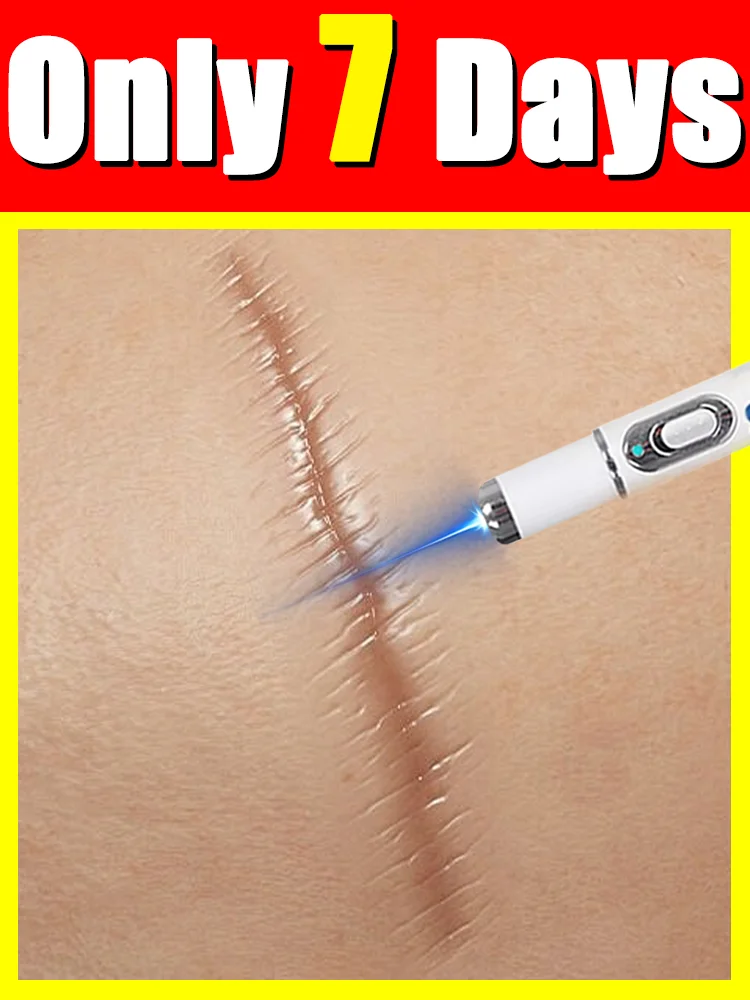 

[2025 New]free shipping,blue light pen solve scar,hotsale scar care tools,painless,free shipping