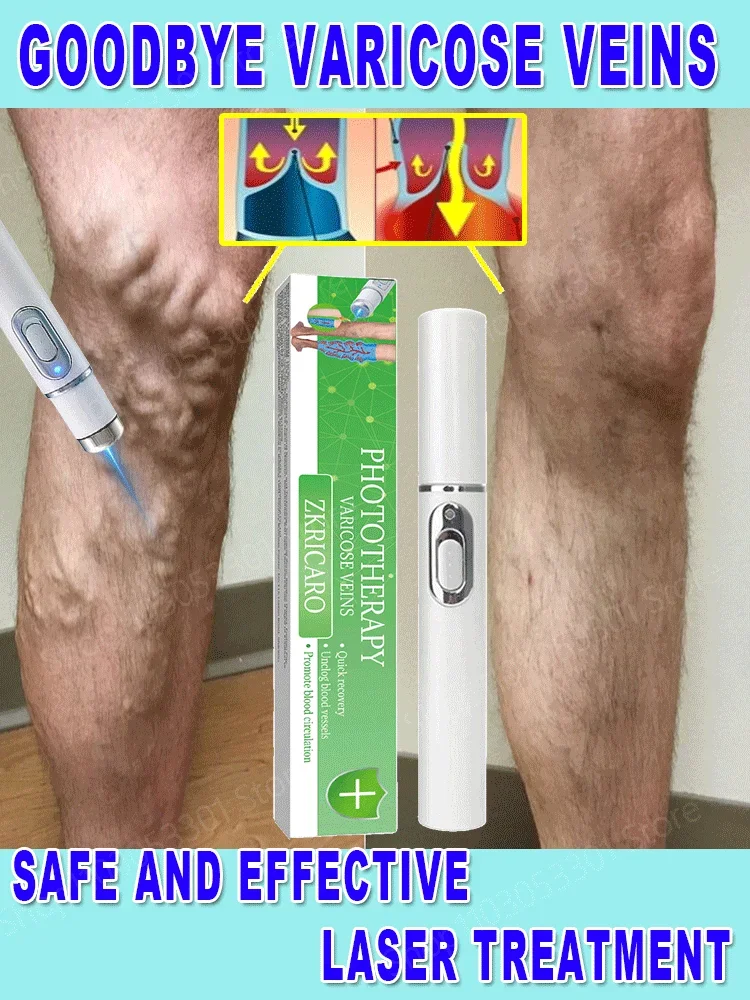 Powerful Laser Therapy for Moderate Varicose Veins, Relieve Pain and Improve Circulation for Both Men and Women