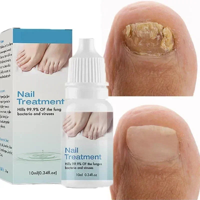 NewNail Fungus Treatment Serum Foot Repair Liquid Toe Nail Fungus Removal Gel Anti Infection Paronychia Onychomycosis Oil0903