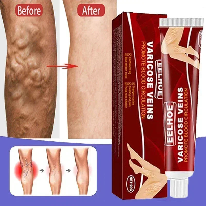 Effective varicose vein soothing cream. Vasculitis, phlebitis, spider leg soothing cream