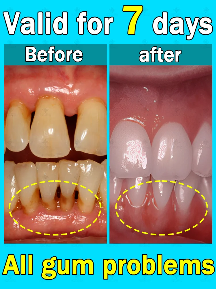 

Rapid sterilization, inhibiting oral problems such as swollen gums, bleeding gums, and gum atrophy