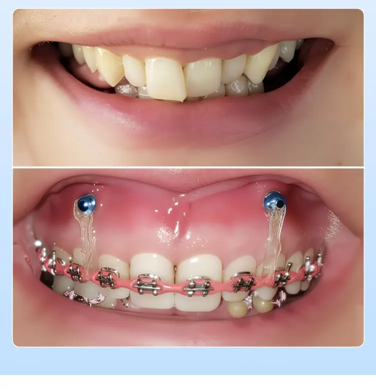 AZDENT Dental Orthodontic Mini-Schraube Sterile Titanlegierung Selbstbohrende Gewindeschrauben Implantat-Mikroschrauben Zahnmedizin – Detail 6